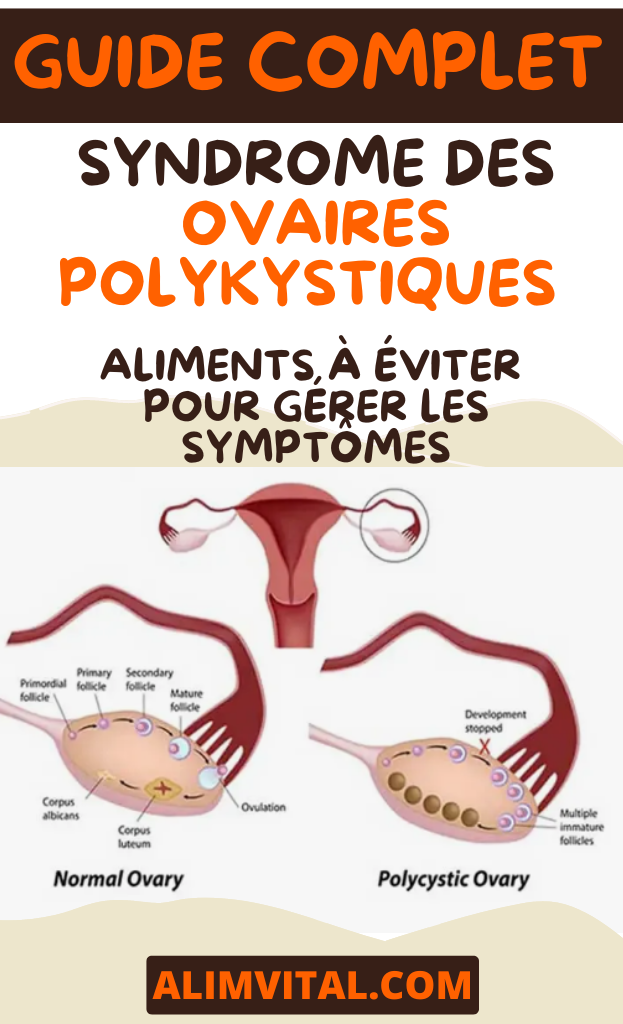 Syndrome des Ovaires Polykystiques